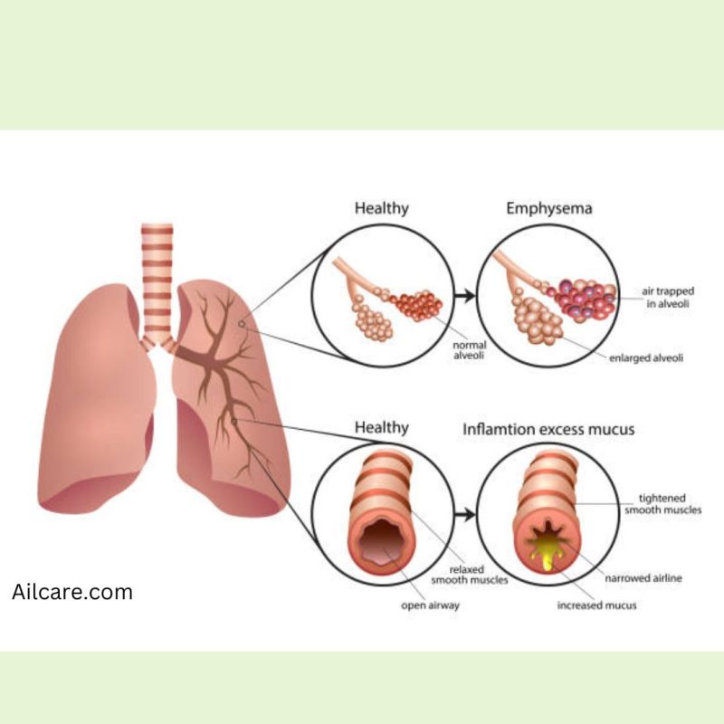 Parts-of-Lung