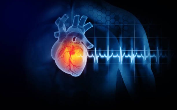  Heart attack